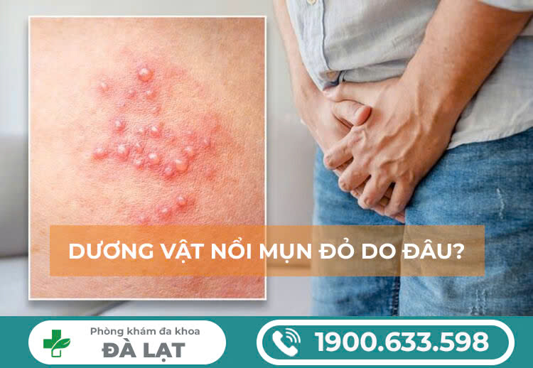 Dương vật nổi mụn đỏ do đâu? Nguyên nhân và cách chữa